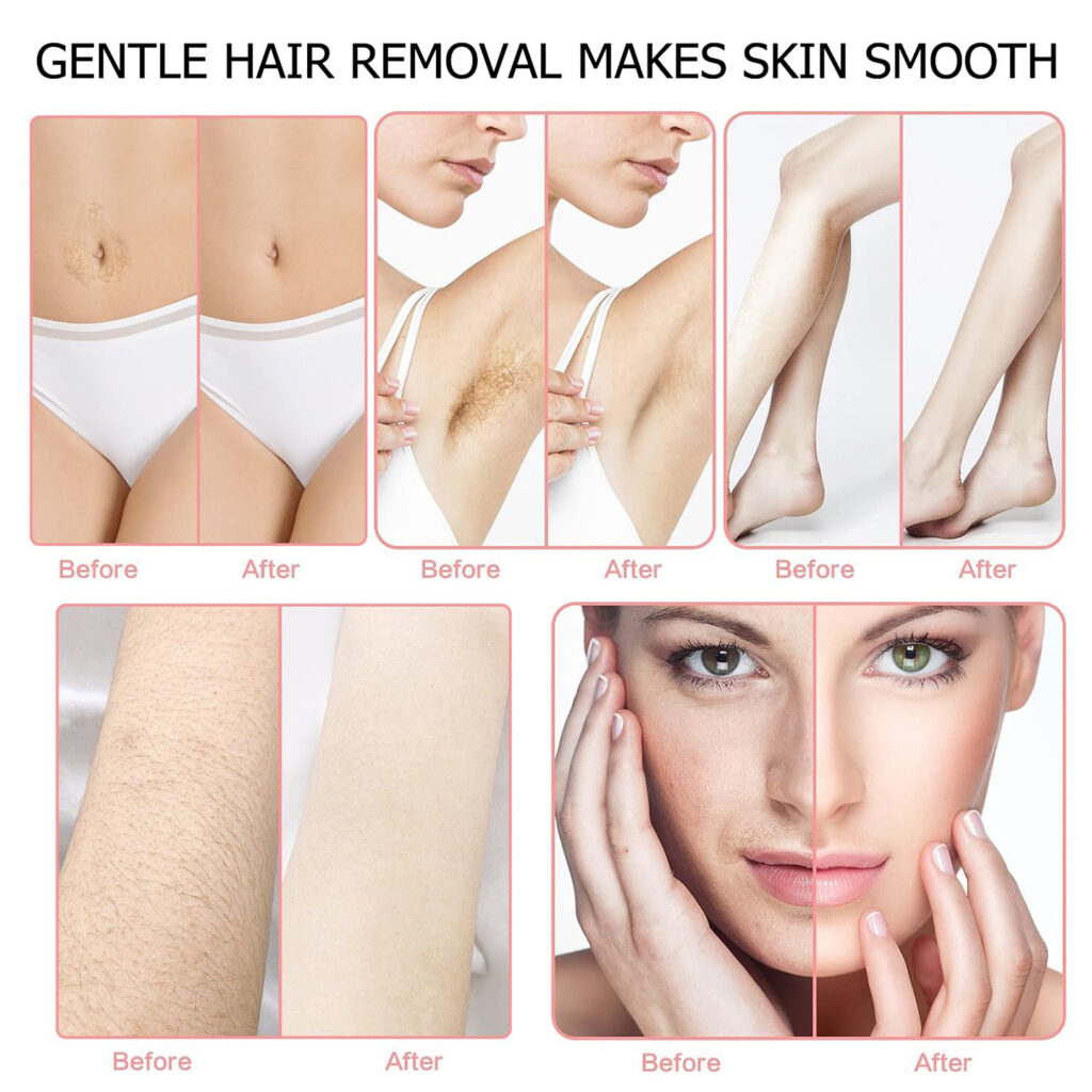 Example of hair removal effect of wax therapy machine